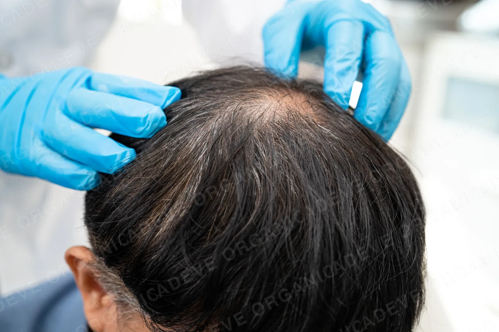 Haar- und Kopfhautanalyse bei Haarausfall in der ADEVE Haarberatung