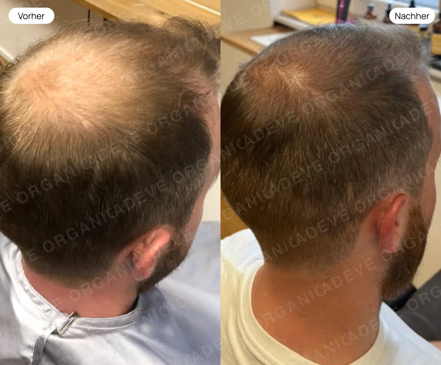 Vorher Nachher Ergebnis bei männlichem Haarausfall